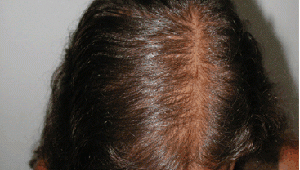 london dermatologist alopecia