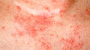 eczema on the neck