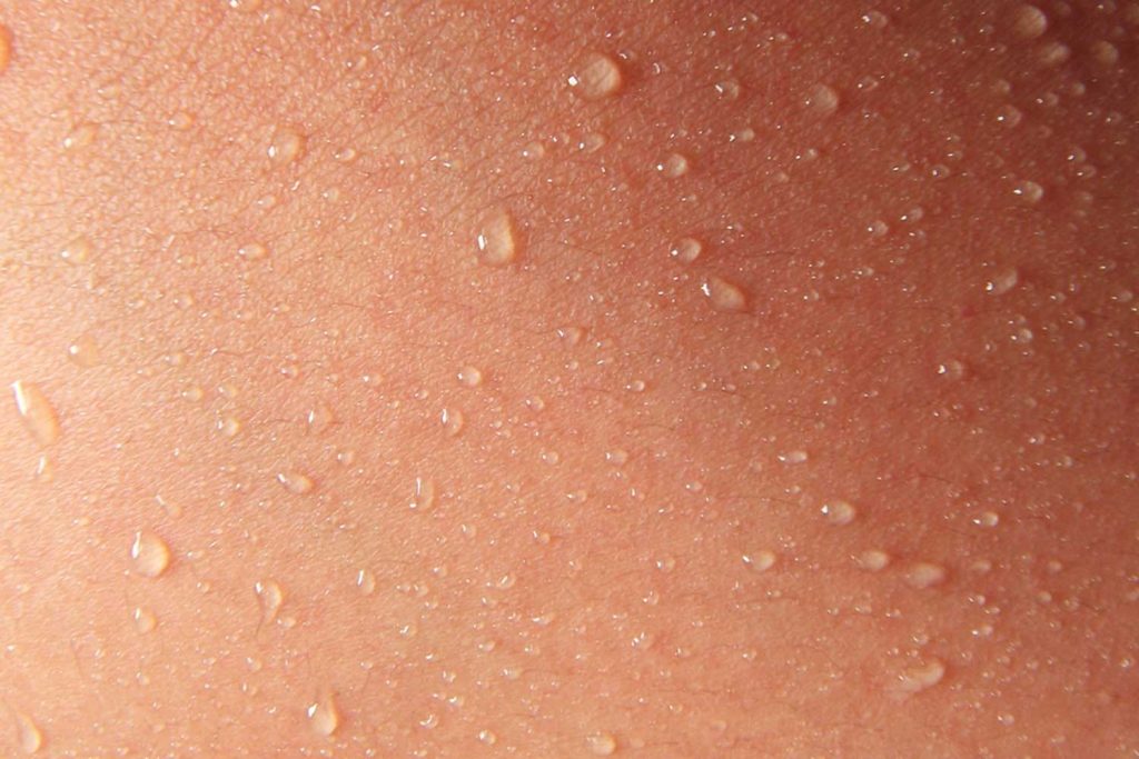 How To Deal With Excessive Sweating The London Dermatologist